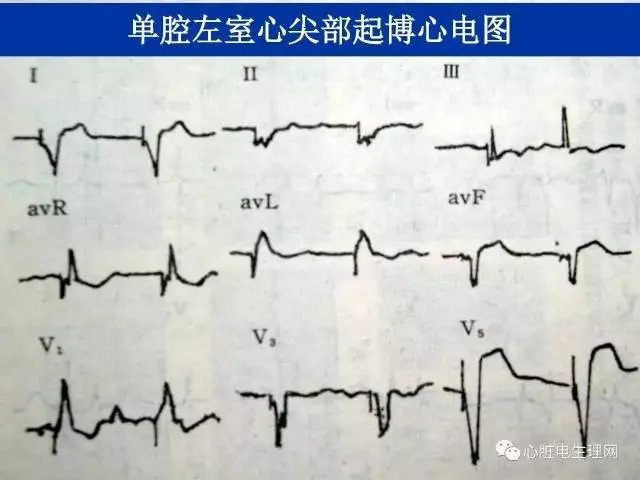 起搏心电图的识别要点