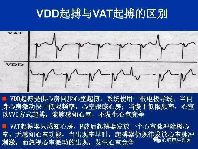 起搏心电图的识别要点