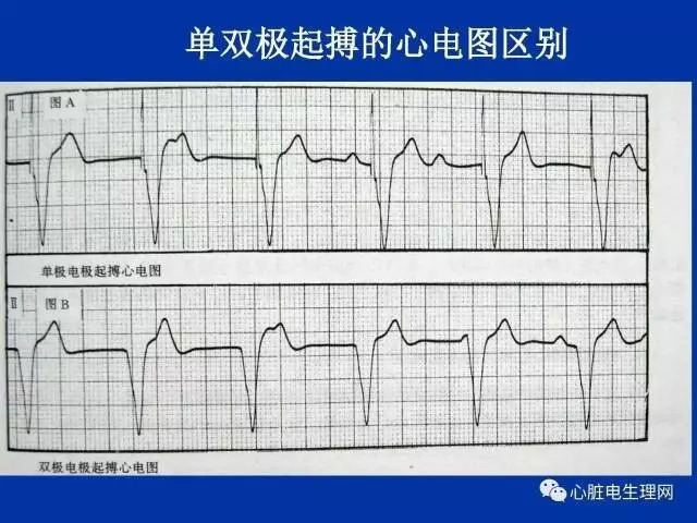 起搏心电图的识别要点