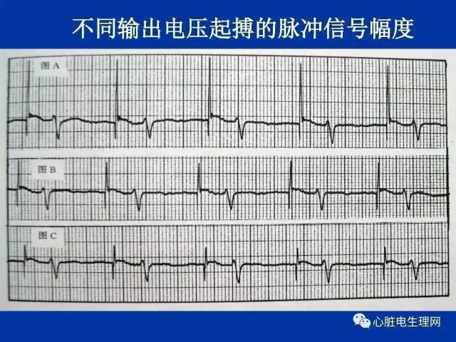 起搏心电图的识别要点