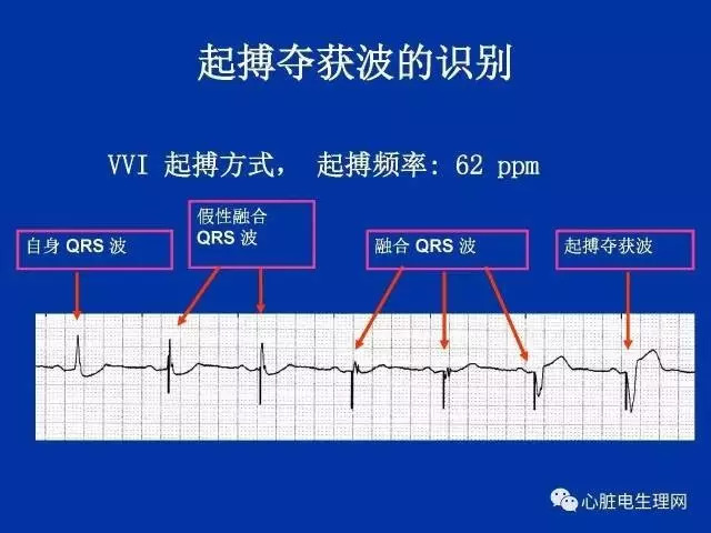 起搏心电图的识别要点