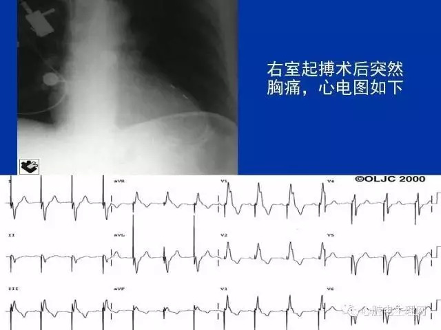 起搏心电图的识别要点