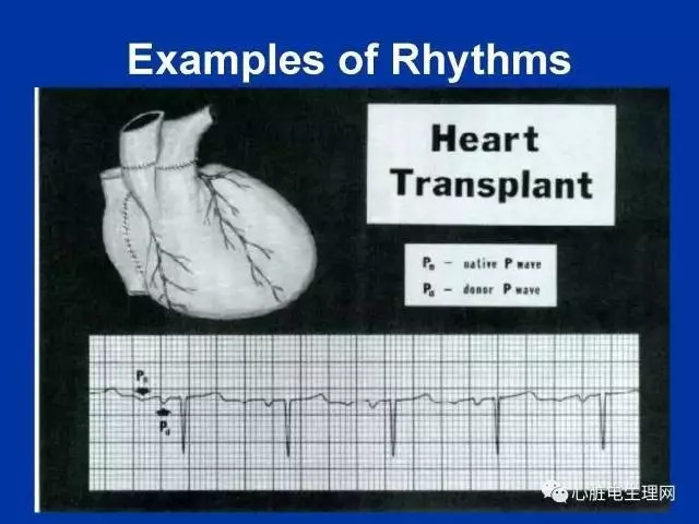 起搏心电图的识别要点