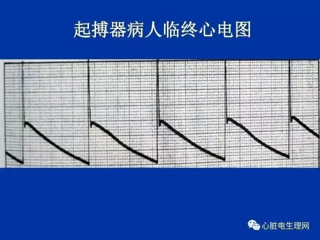 起搏心电图的识别要点