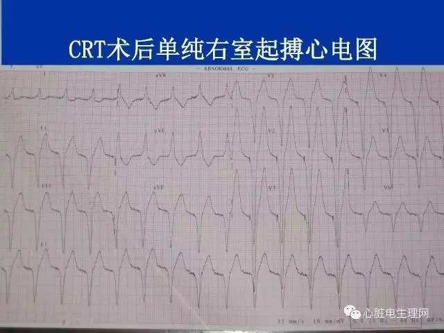 起搏心电图的识别要点