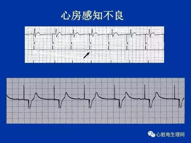 起搏心电图的识别要点