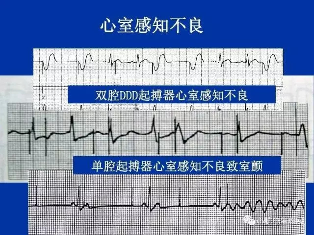 起搏心电图的识别要点