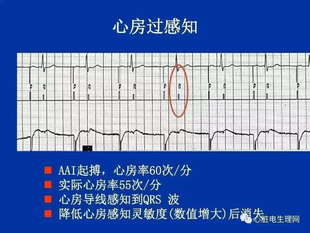 起搏心电图的识别要点