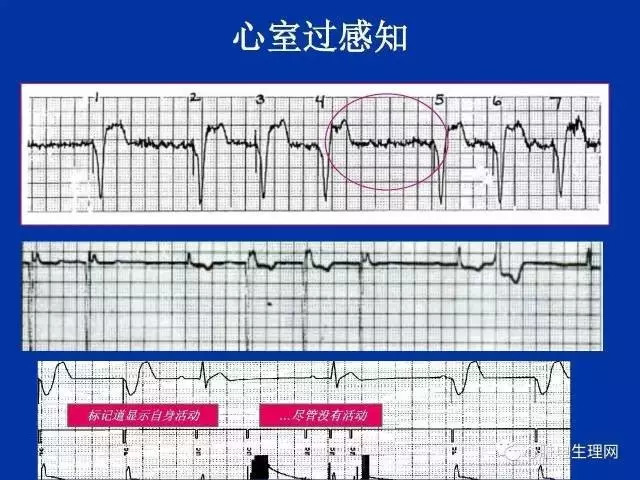 起搏心电图的识别要点