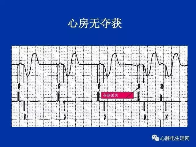 起搏心电图的识别要点