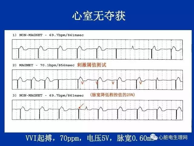 起搏心电图的识别要点