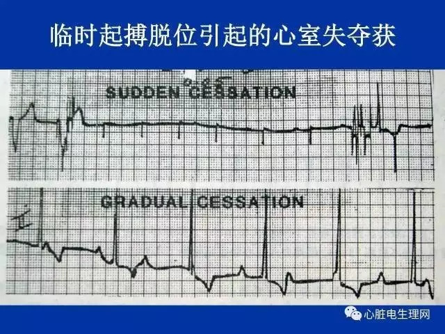 起搏心电图的识别要点