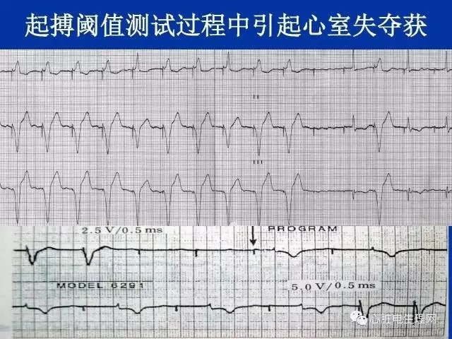 起搏心电图的识别要点