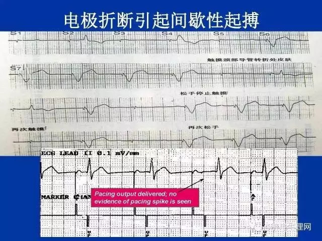 起搏心电图的识别要点