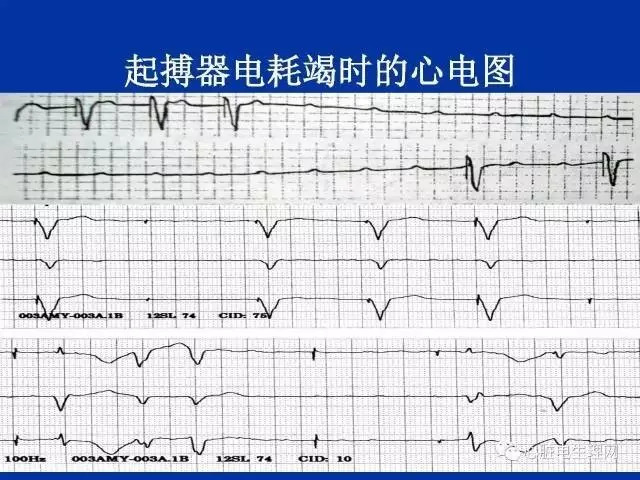 起搏心电图的识别要点