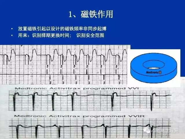 起搏心电图的识别要点