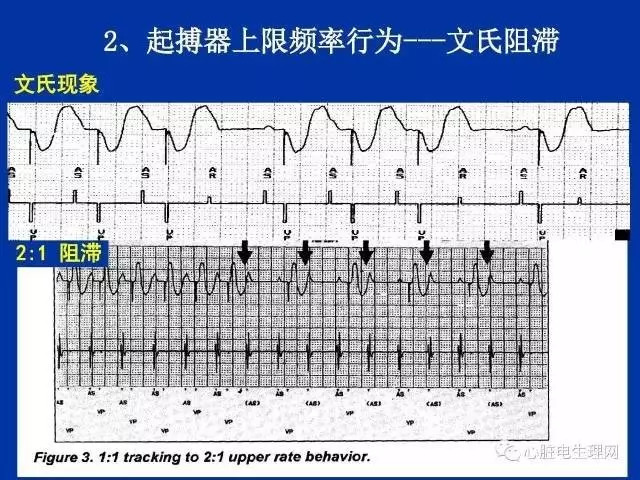 起搏心电图的识别要点