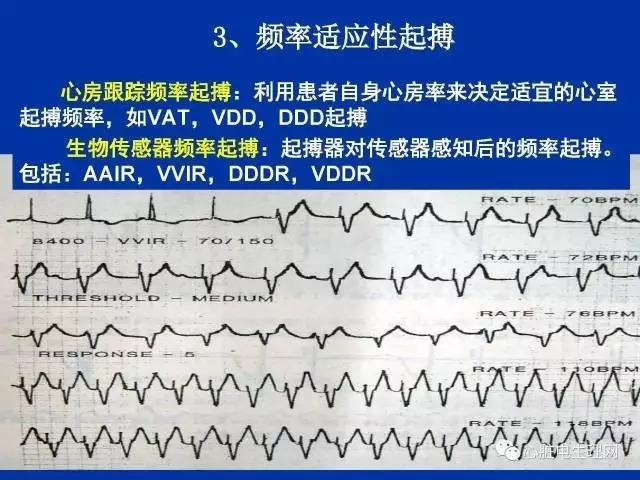 起搏心电图的识别要点