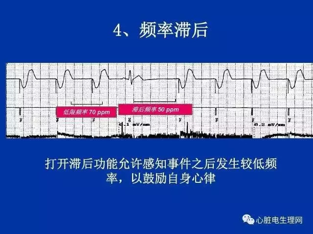 起搏心电图的识别要点