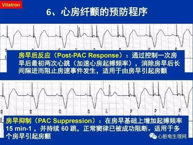 起搏心电图的识别要点