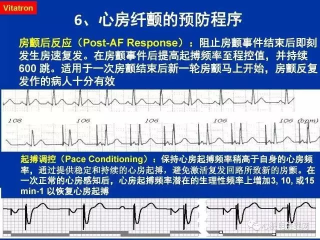 起搏心电图的识别要点