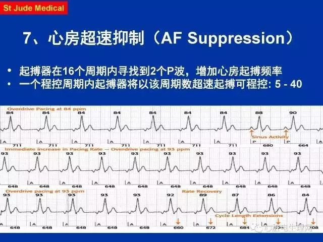 起搏心电图的识别要点