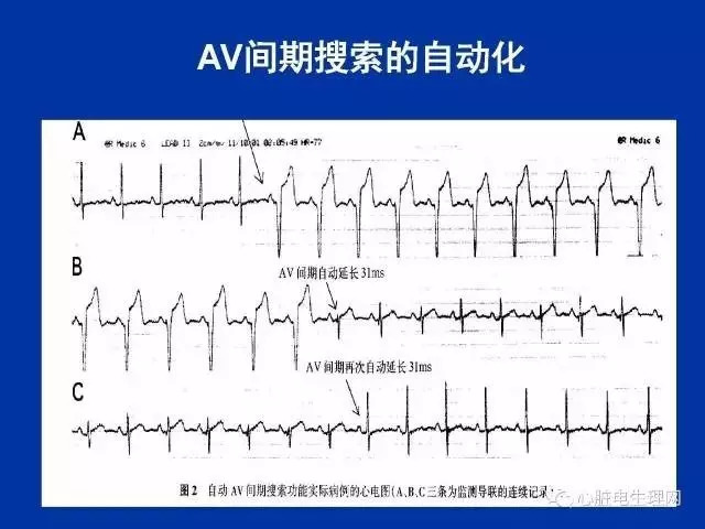 起搏心电图的识别要点