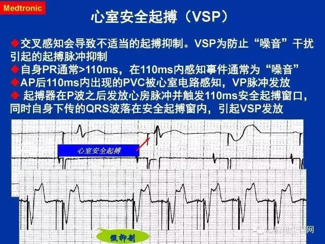 起搏心电图的识别要点