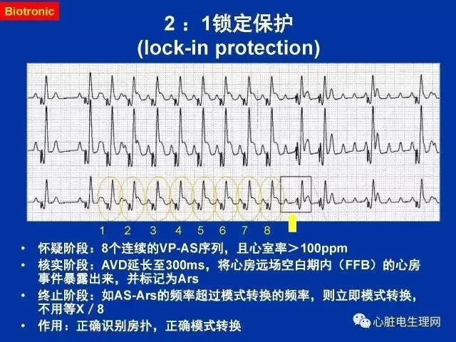 起搏心电图的识别要点