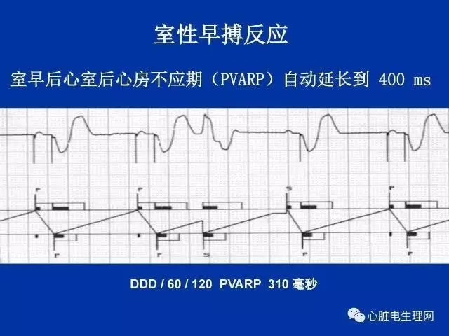 起搏心电图的识别要点