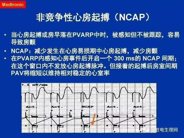 起搏心电图的识别要点