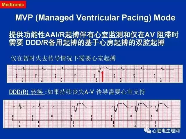 起搏心电图的识别要点