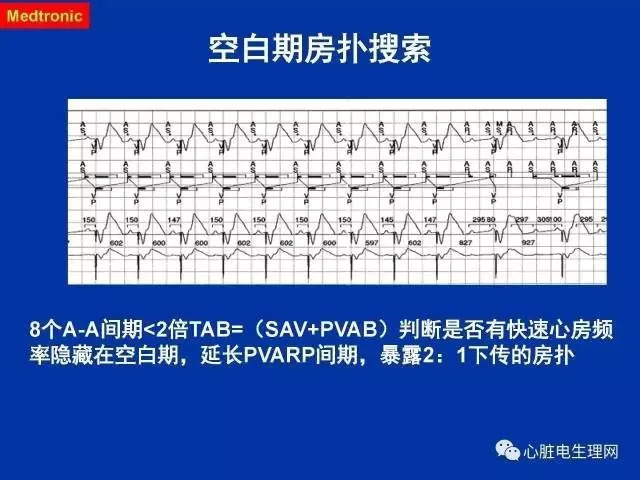 起搏心电图的识别要点
