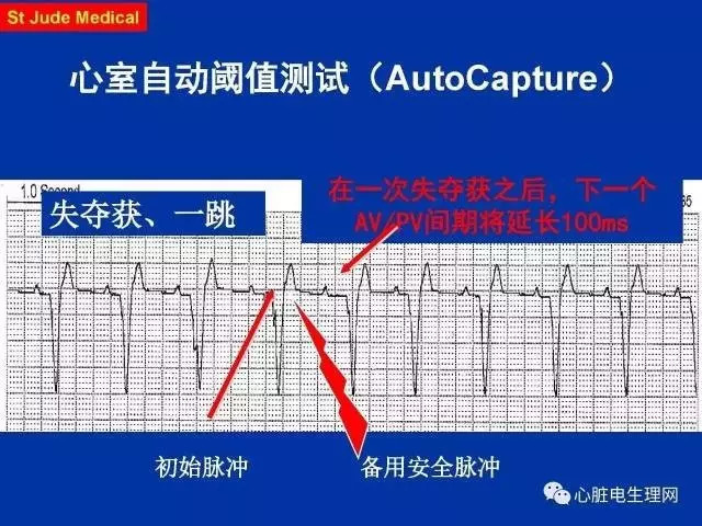 起搏心电图的识别要点