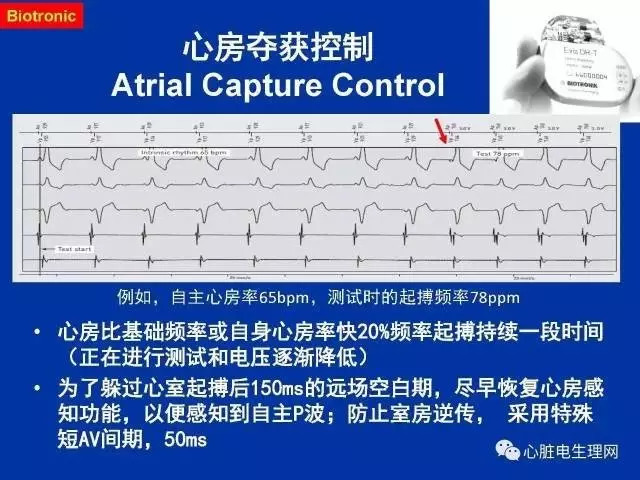 起搏心电图的识别要点