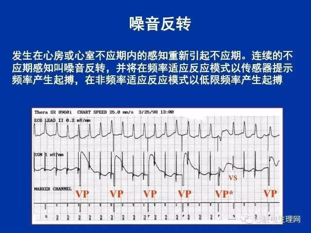 起搏心电图的识别要点