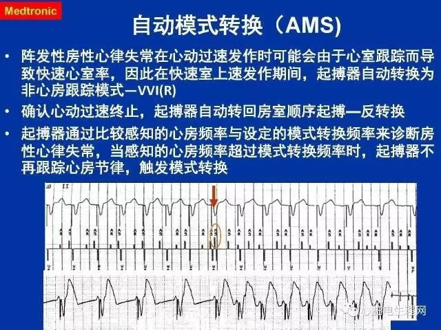 起搏心电图的识别要点