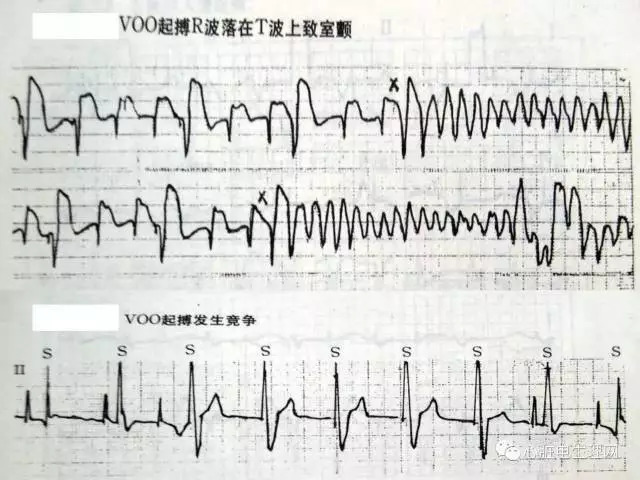 起搏心电图的识别要点