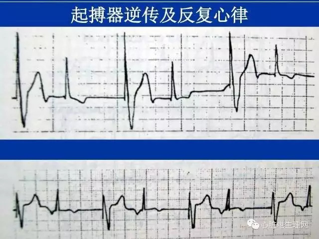 起搏心电图的识别要点