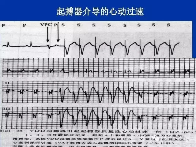 起搏心电图的识别要点