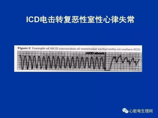 起搏心电图的识别要点