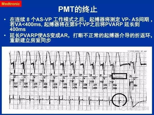 起搏心电图的识别要点