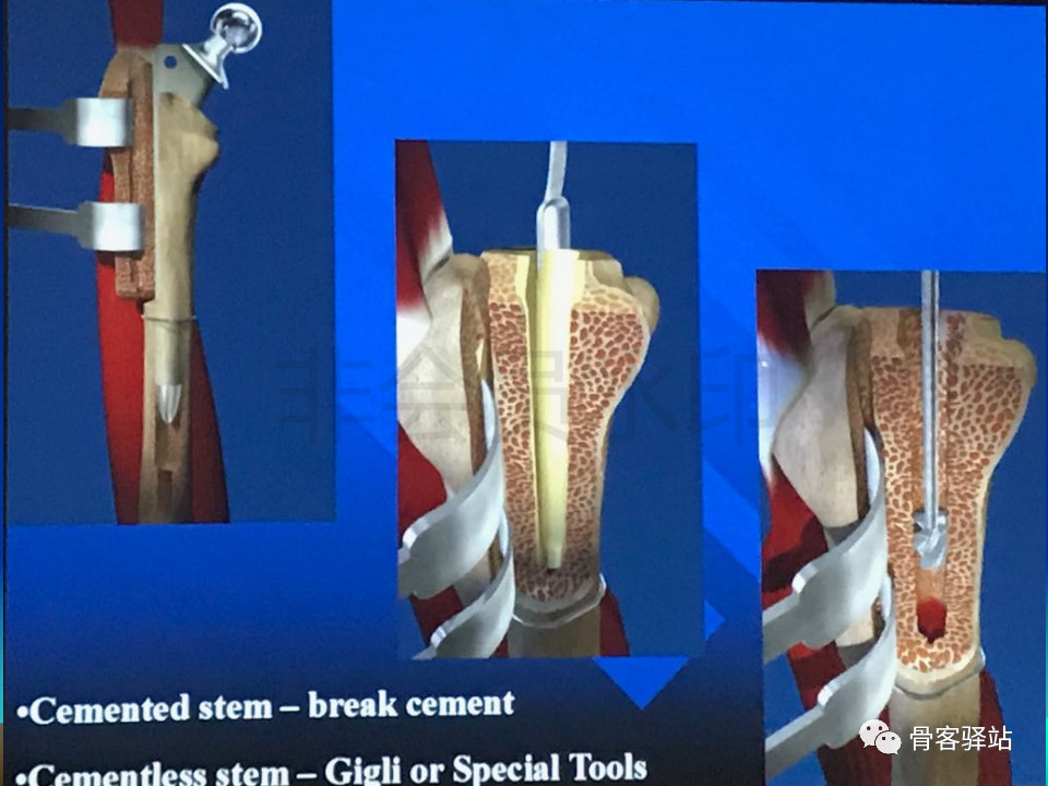 大转子延长截骨----股骨近端畸形髋重建必备技能