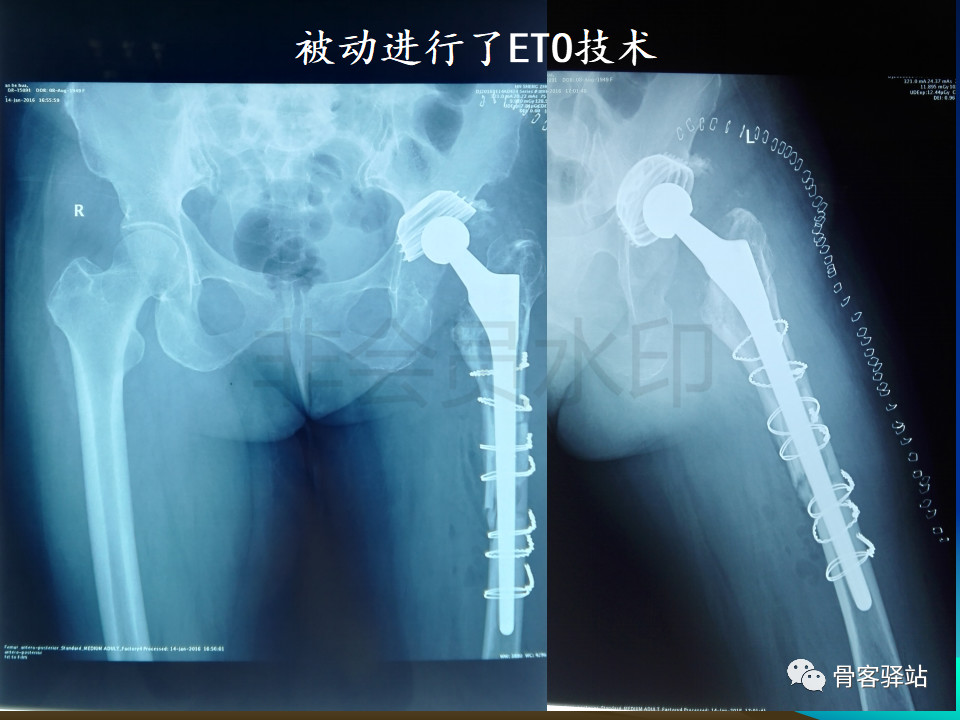 大转子延长截骨----股骨近端畸形髋重建必备技能