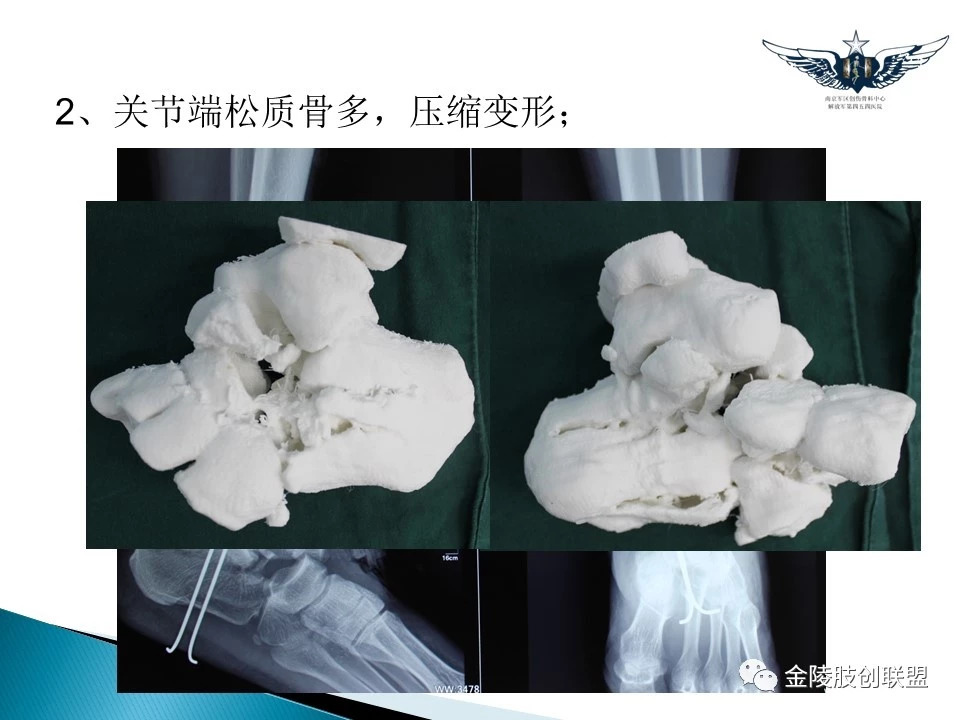3D打印技术在骨科中的应用，你了解吗？