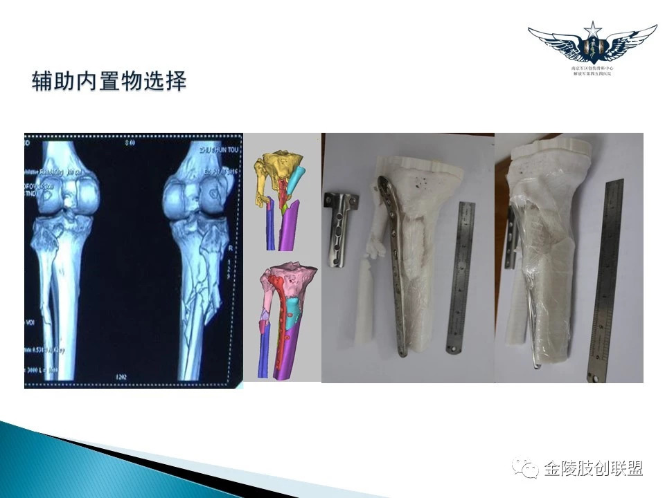 3D打印技术在骨科中的应用，你了解吗？
