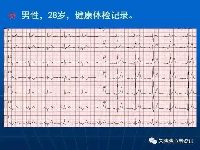 心电图判读