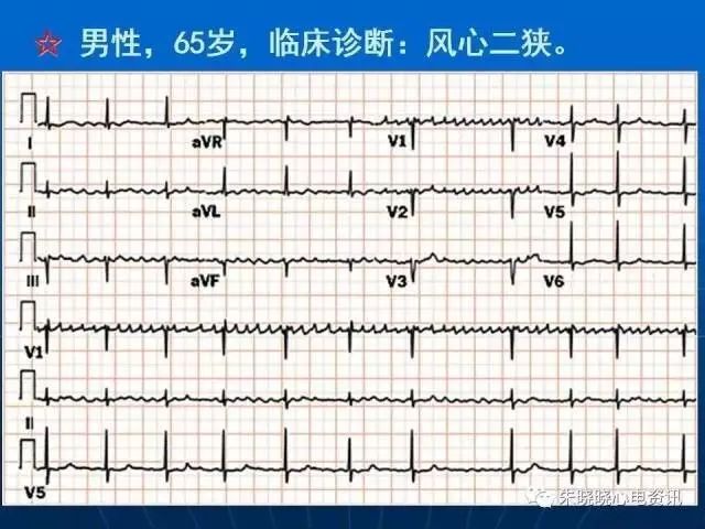 心电图判读