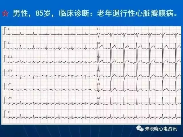 心电图判读