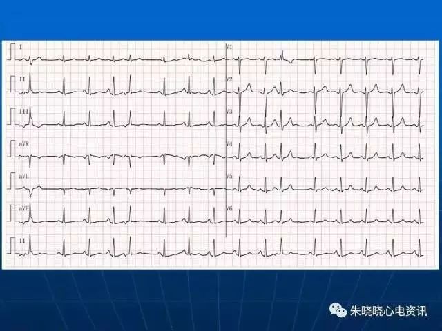 心电图判读